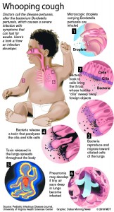 Whooping cough Image